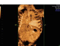 Bronchopulmonary sequestration coronal 3D